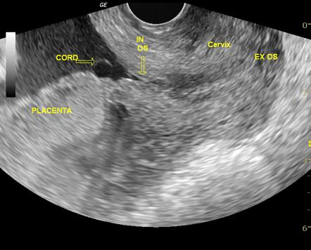 A second ultrasound showing vasa previa