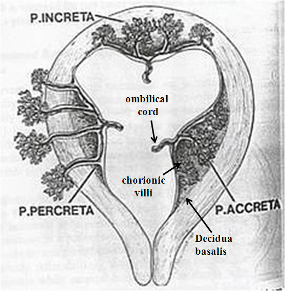 Abnormal placentation