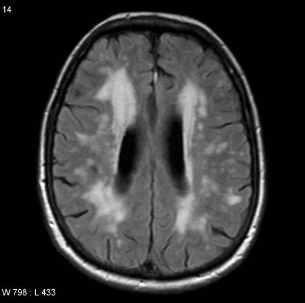 CT Vascular Dementia