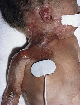 Cicatrical skin lesions in congenital VZV