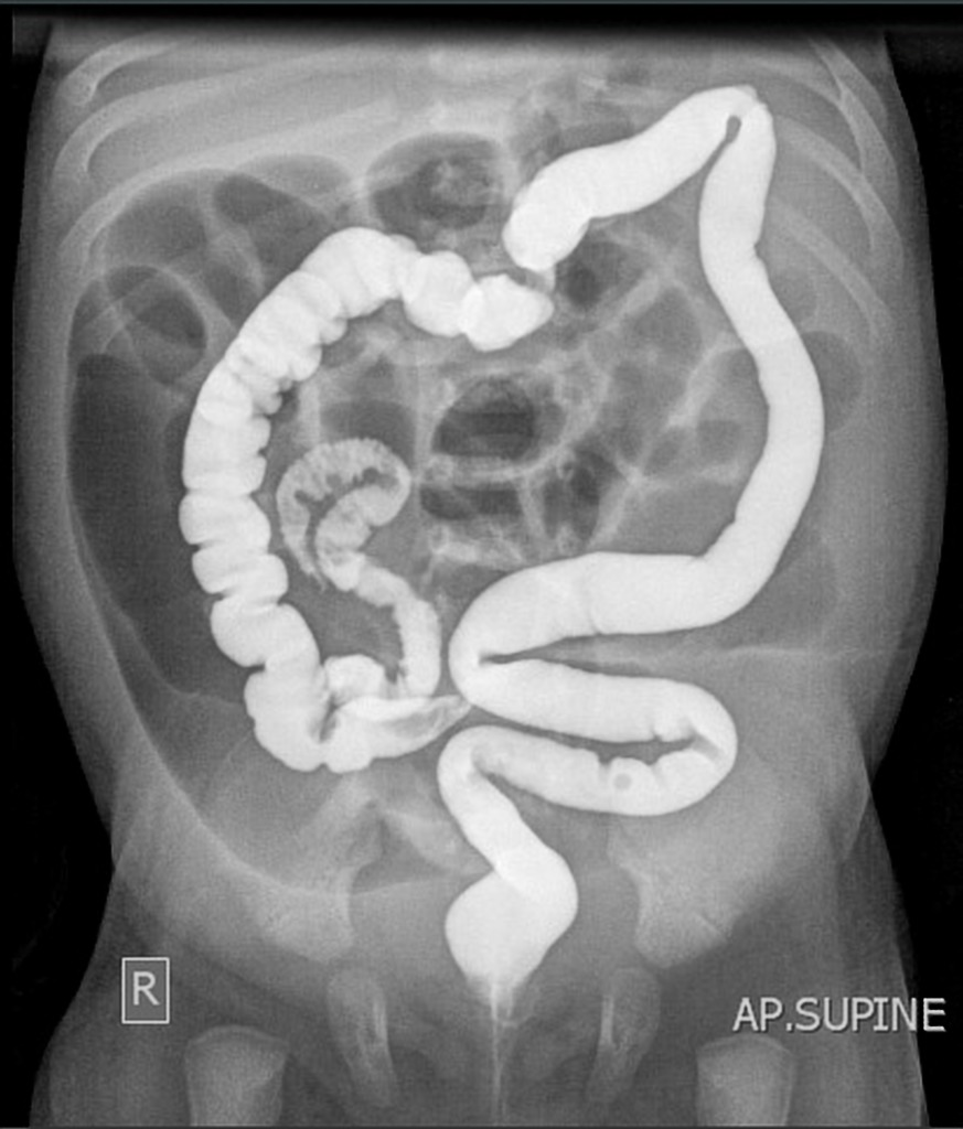 Colonic atresia with microcolon in Abdominal XR with contrast enema