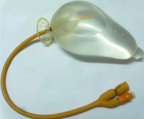 Condom tamponade