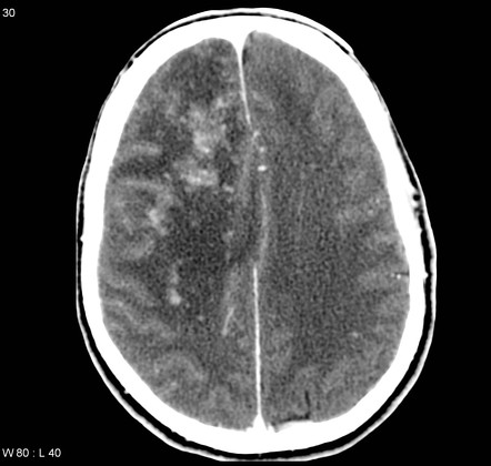 Diffuse Intracranial Calcifications