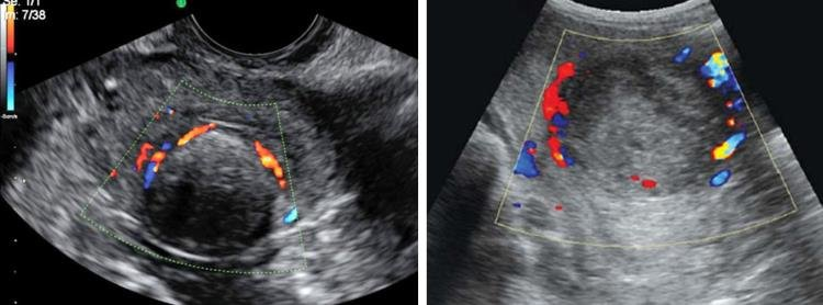 Doppler showing a rim of blood flow around a fibroid