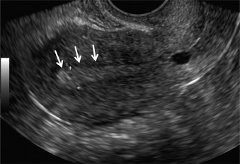 Endometrial cancer on ultrasound