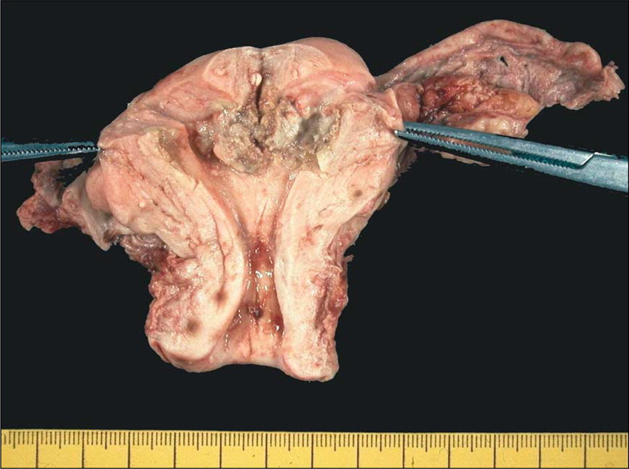 Endometrial carcinoma