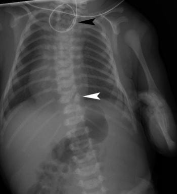 Esophageal Atreasia on X-ray