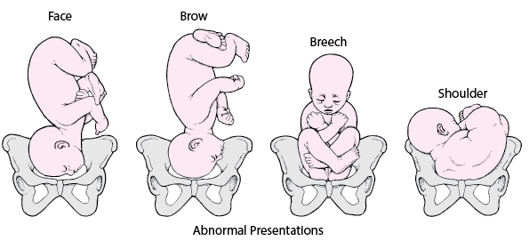 Fetal Presentation