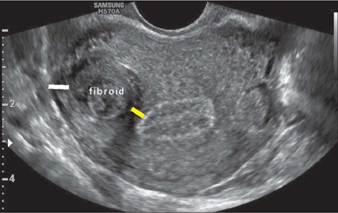 Fibroid on ultrasound