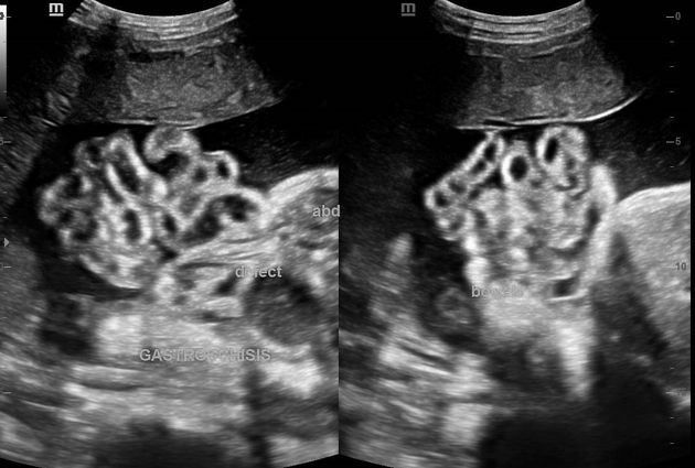 Gastroschisis on obstetric scan