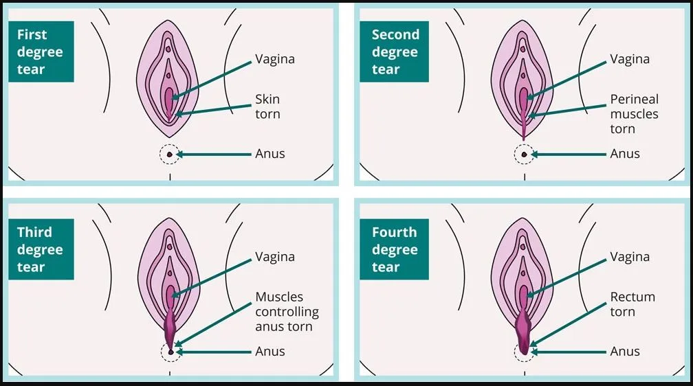 Grading of perineal tears