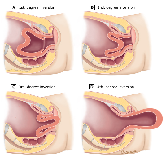 Grading of uterine inversion