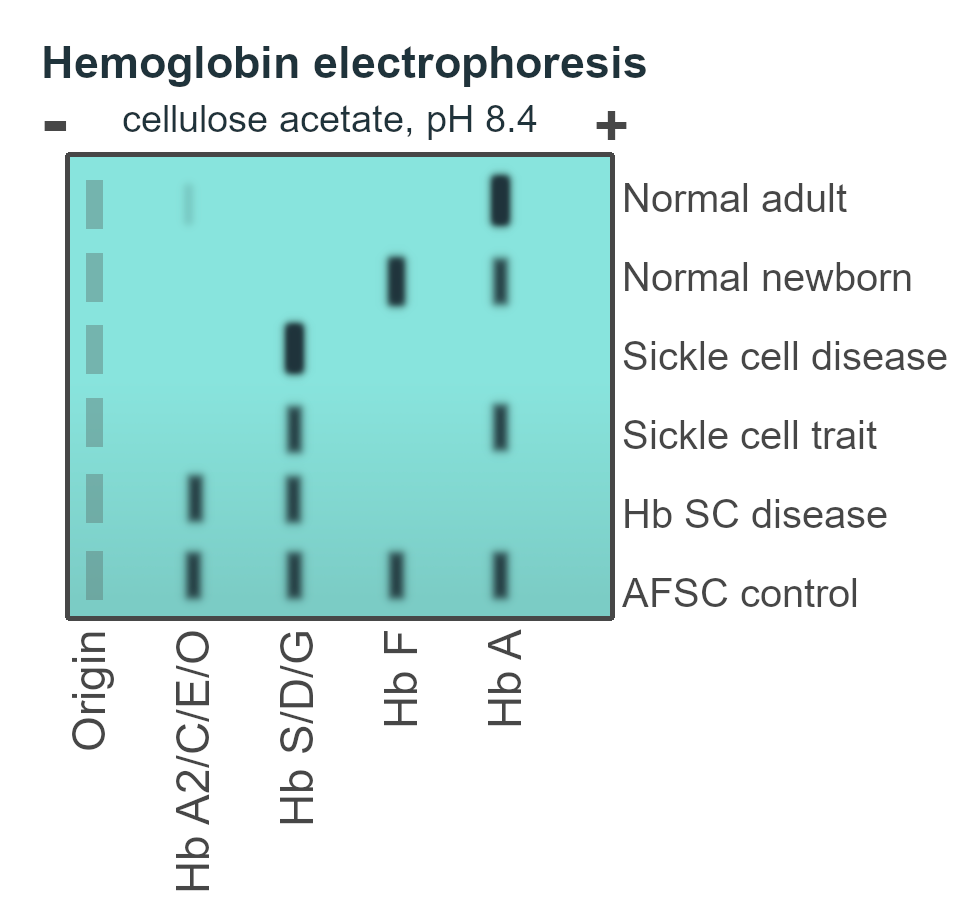 Hemoglobin electrophoresis
