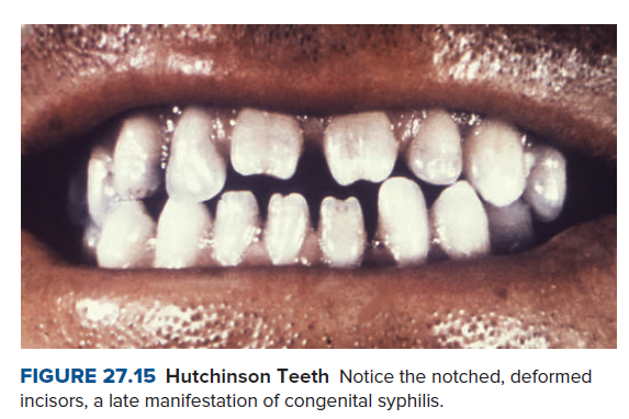 Hutchinson Teeth