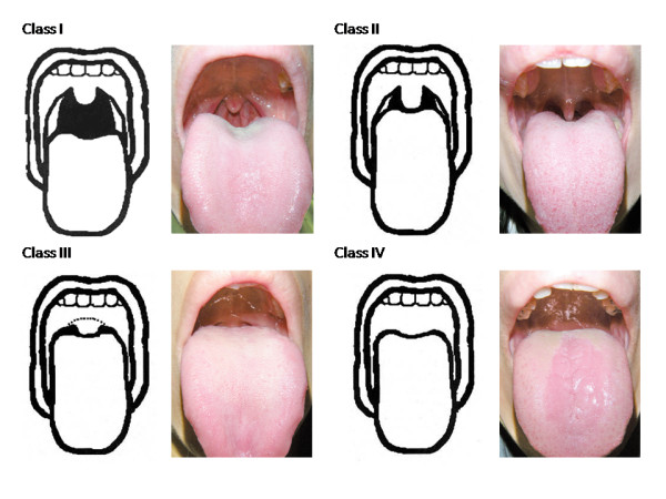 Malampatti classification to assess the difficulty of intubation