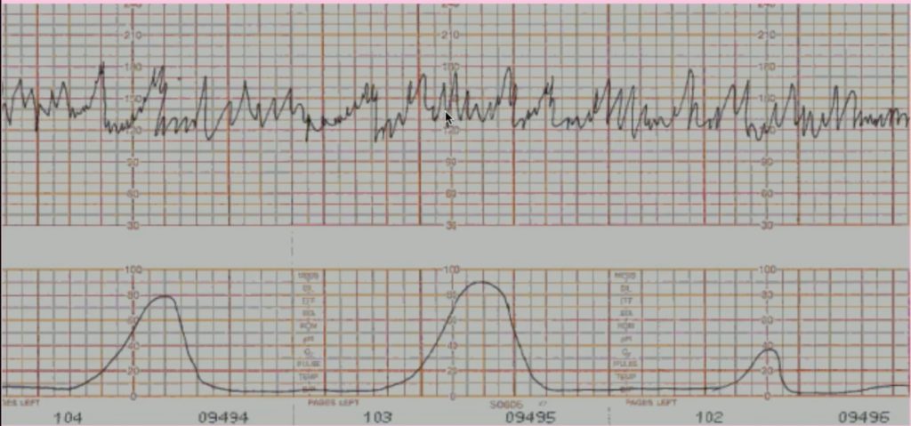 Marked variability (difference of 70 bpm)