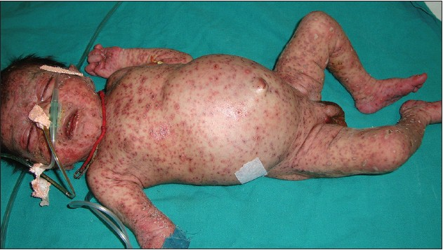 Neonatal varicella