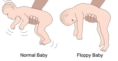 Normal vs Floppy Baby