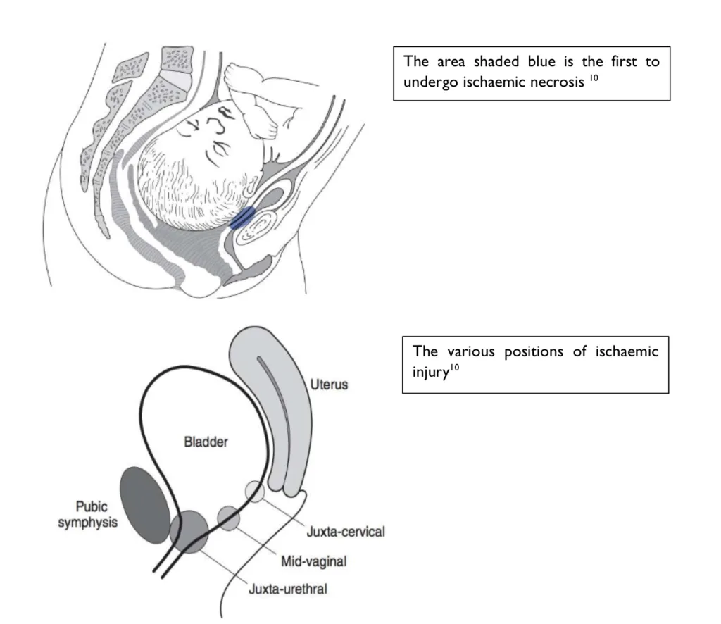Pathophysiology of obstetric fistula
