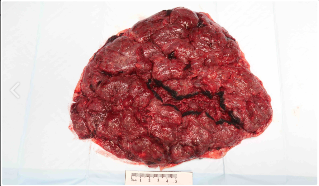 Placenta with disrupted maternal surface