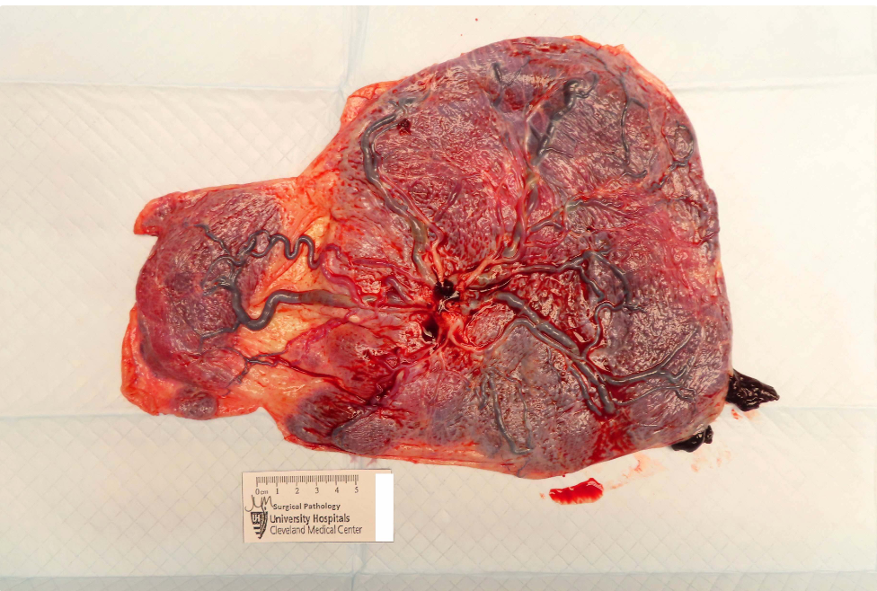 Placenta with succenturiate lobe