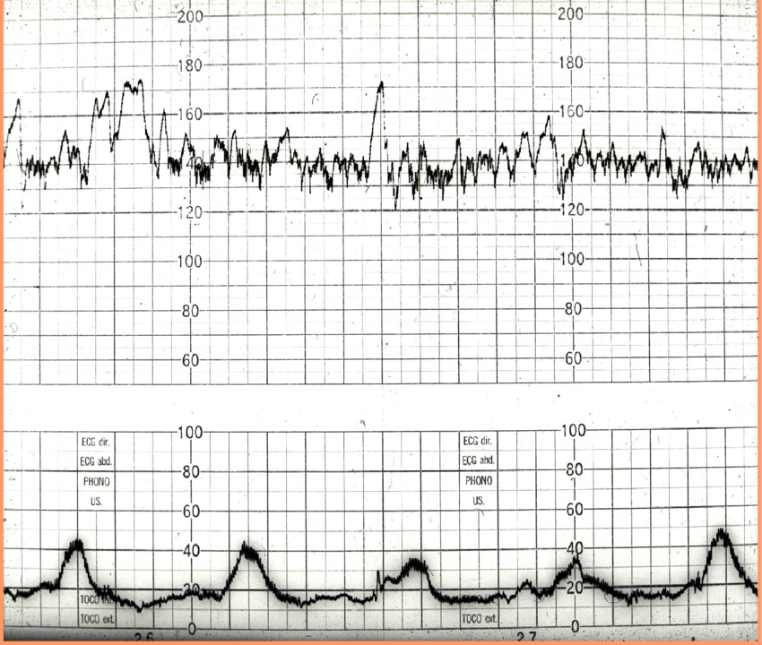 Reactive CTG with a baseline fetal heart rate of about 140bpm