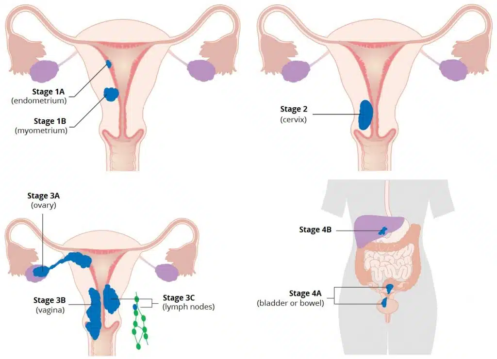 Staging of endometrial carcinoma