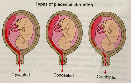 Types of Abruptio Placentae