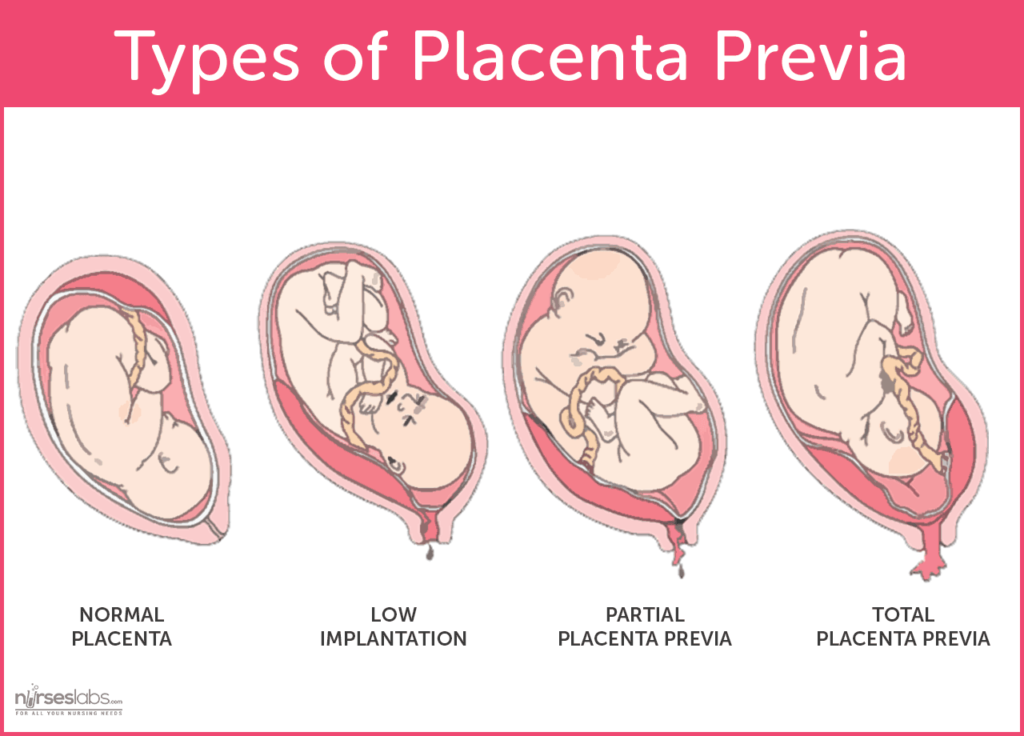Types of Placenta Previa