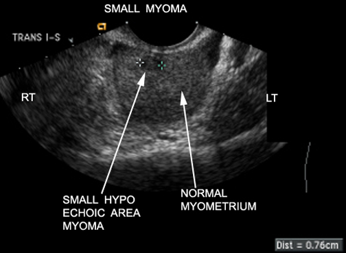 Ultrasound showing a small fibroid