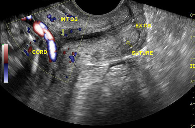 Ultrasound showing vasa previa