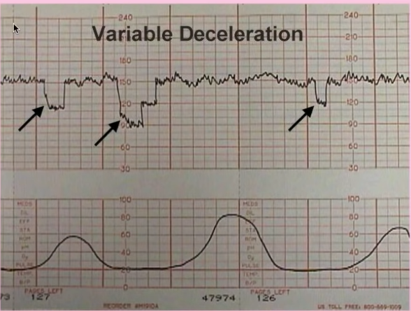 Variable decelerations