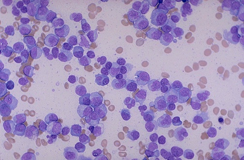 Bone marrow aspirate showing numerous plasma cells with eccentric nuclei and perinuclear hof