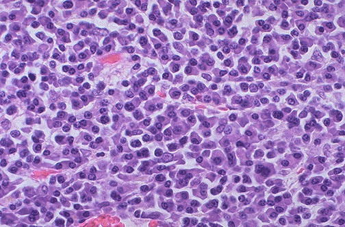 Bone marrow biopsy showing numerous plasma cells