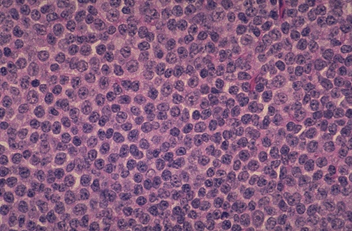 Diffuse Large B-cell Lymphoma 2