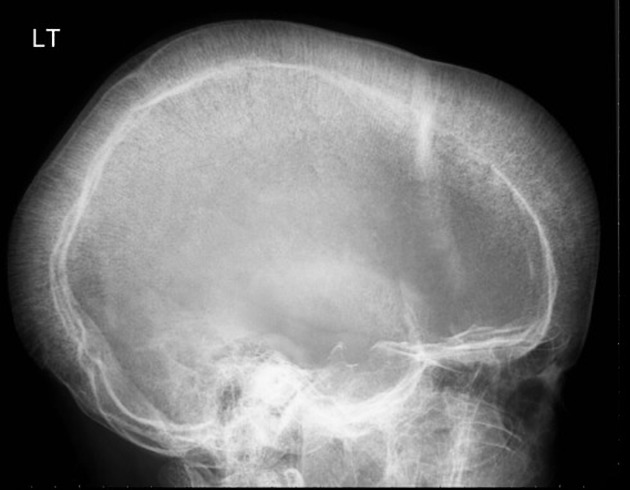 Hair-on-end appearance on Skull X-ray in Thalassemia