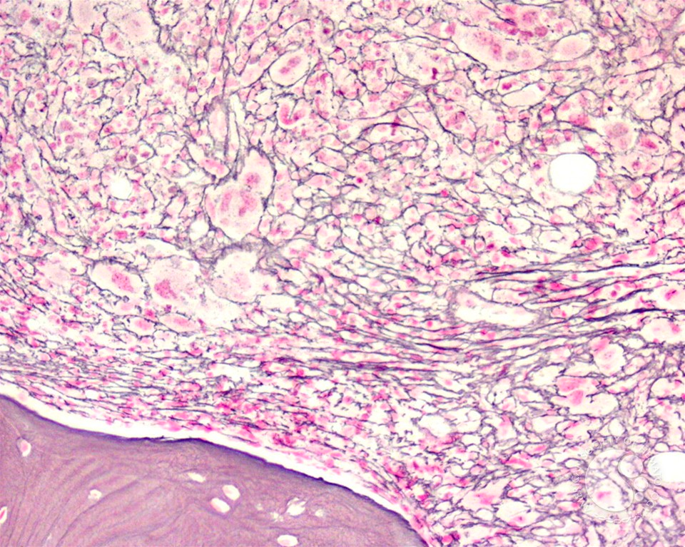 Myelofibrosis grade 3. Reticulin fibers stain black.