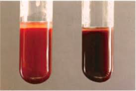 Normal blood on the left vs brown methemoglobin-containing blood on the right