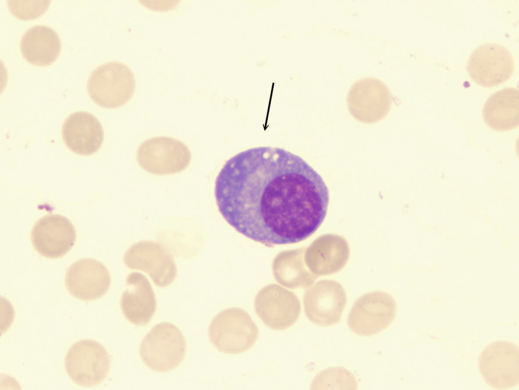 Normal plasma cell