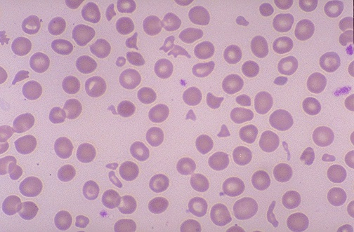 Schistocytes and helmet cells