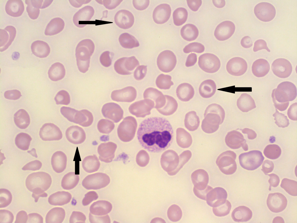 Target cells - Mexican hat cells - in Thalassemia