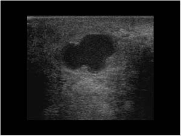 Breast Abscess on Ultrasound