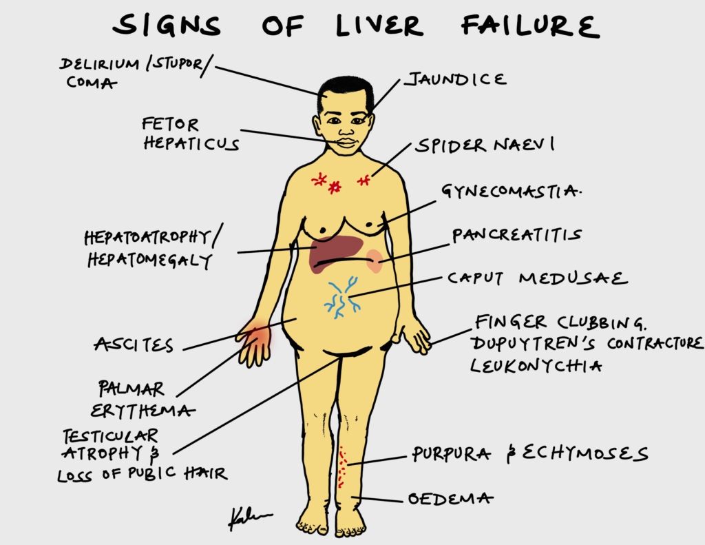 Signs of liver failure