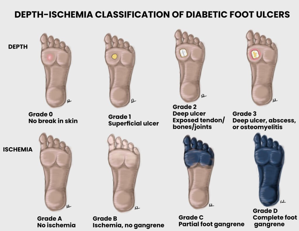 Depth-ischemia classification of diabetic foot ulcer