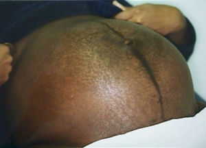Linea nigra and striae gravidarum