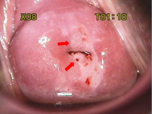 Acetowhite area extending into the endocervical canal and is located within the Transformation Zone
