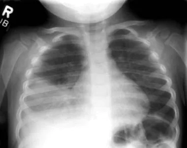 Bacterial Pneumonia