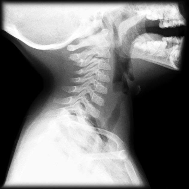 Bacterial tracheitis on lateral neck X-ray