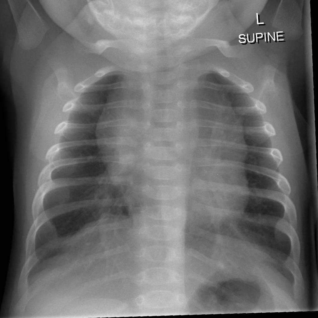 Bronchiolitis