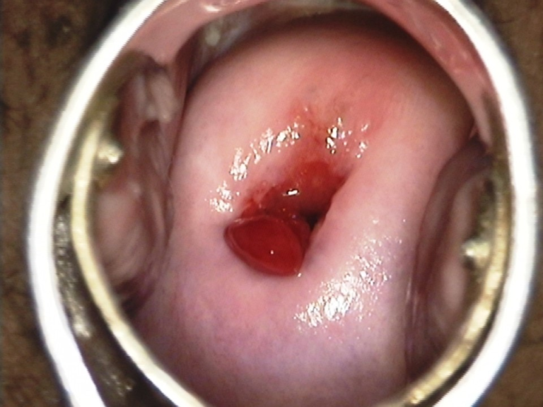 Cervical polyp